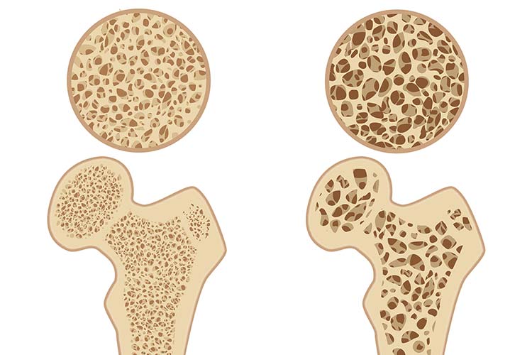 骨粗しょう症